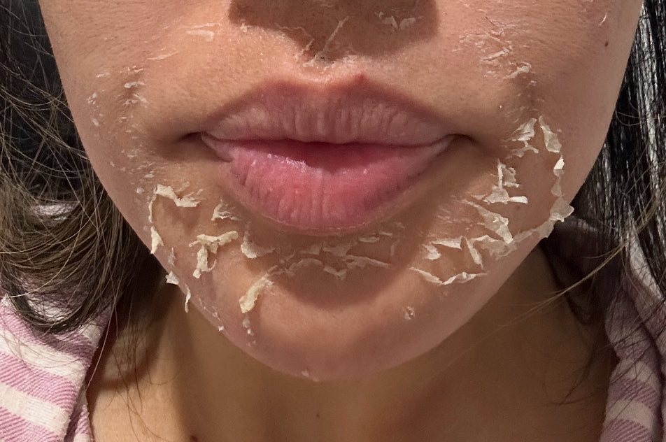 VI Peel (Regular price $350)